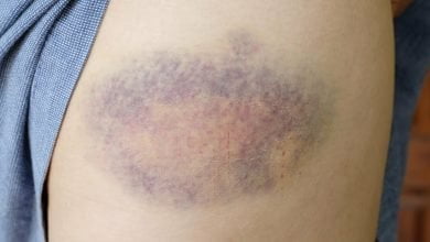 foto de hematomas en el brazo