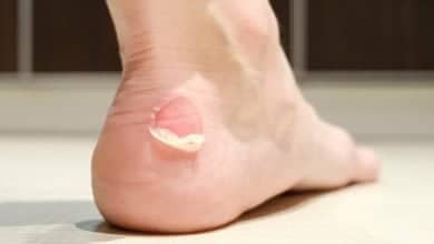 Pie con ampollas reventadas