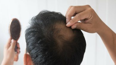 Los hombres est&aacute;n preocupados por la ca&iacute;da del cabello / p&eacute;rdida de cabello / ca&iacute;da del cabello en los hombres