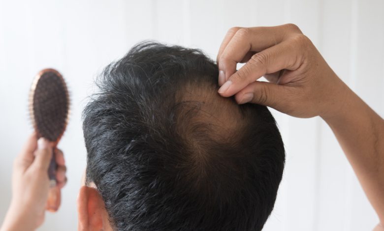 Los hombres están preocupados por la caída del cabello / pérdida de cabello