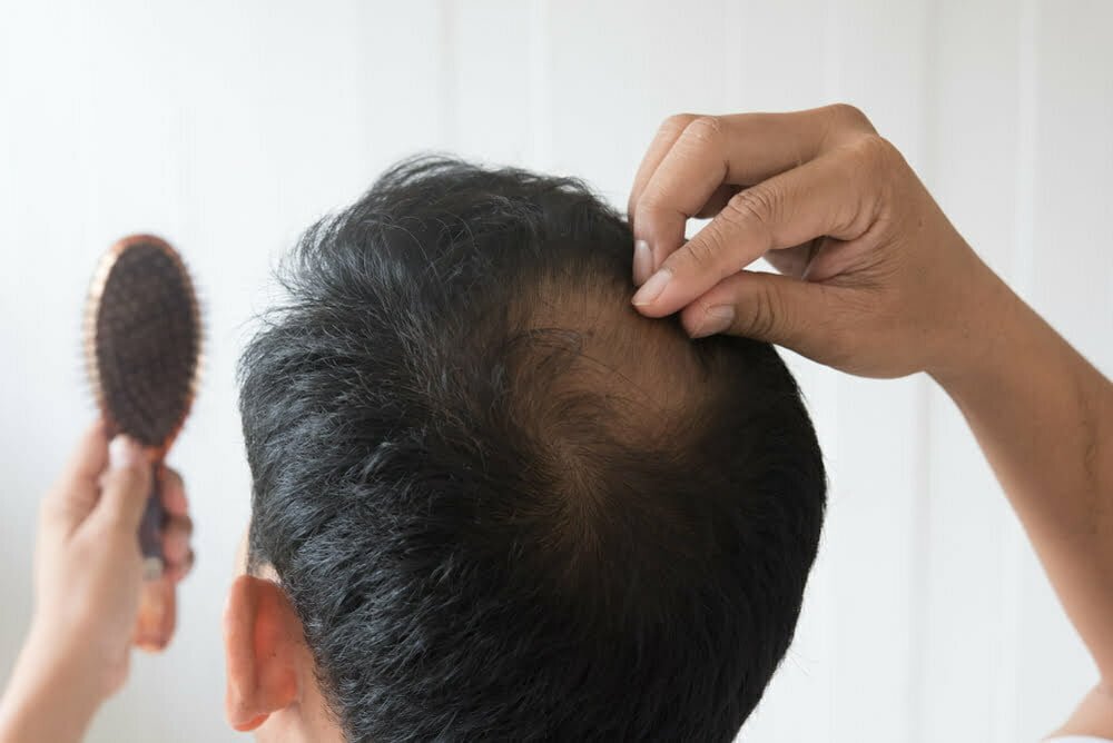 Los hombres est&aacute;n preocupados por la ca&iacute;da del cabello / p&eacute;rdida de cabello / ca&iacute;da del cabello en los hombres
