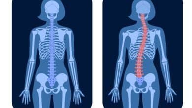 dibujo de rayos X de persona con escoliosis y de una columna normal