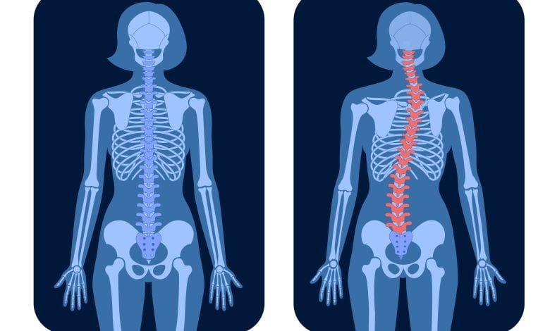 dibujo de rayos X de persona con escoliosis y de una columna normal