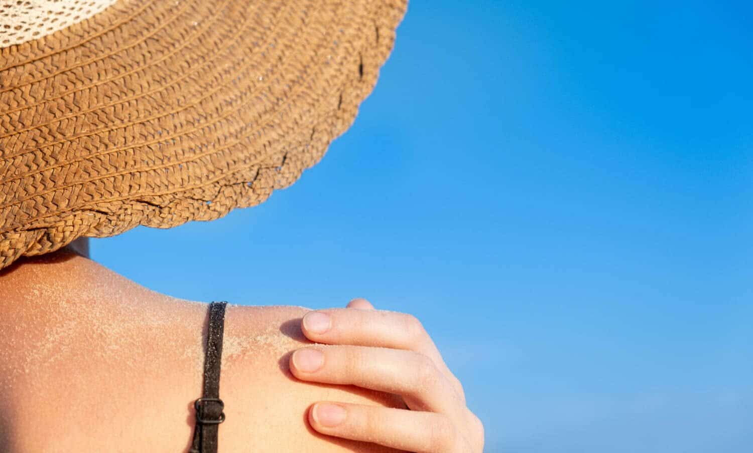 hombro de mujer que su piel se pela por el sol