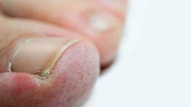 hongos de las u&ntilde;as - hongos en las u&ntilde;as