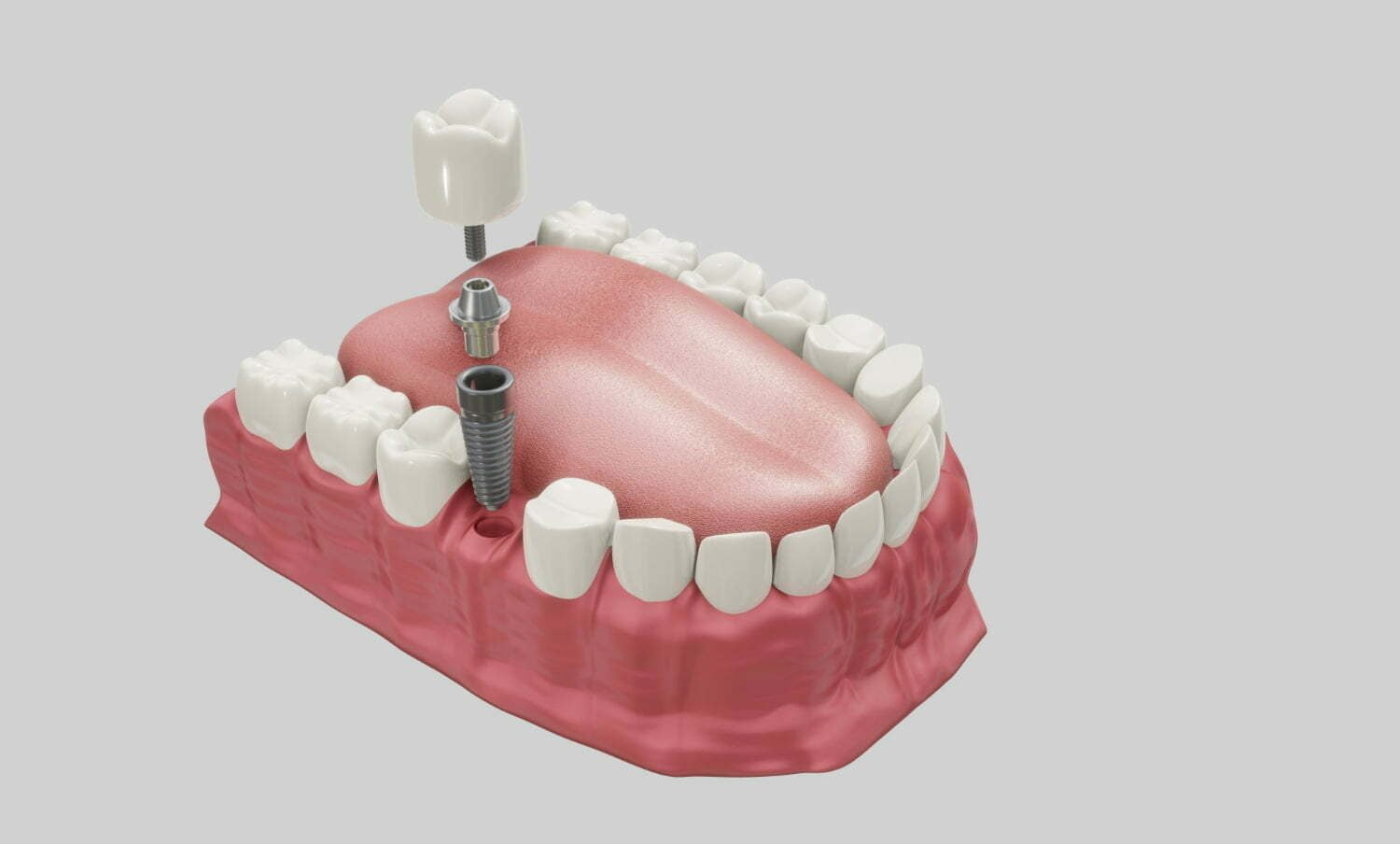 Ilustración de cómo se ven los implantes dentales y sus partes