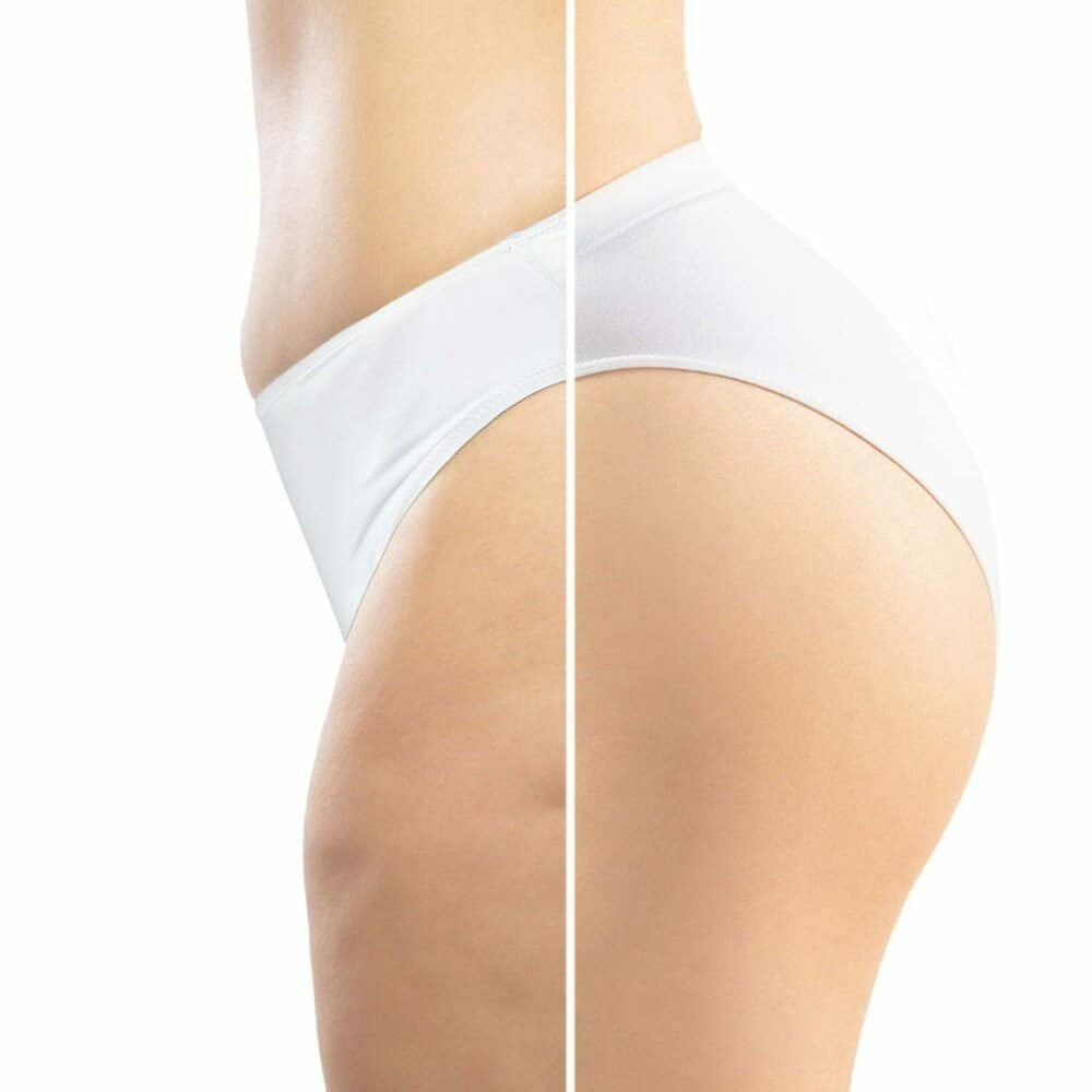 aparici&oacute;n de celulitis en cuerpo de mujer
