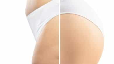 aparici&oacute;n de celulitis en cuerpo de mujer