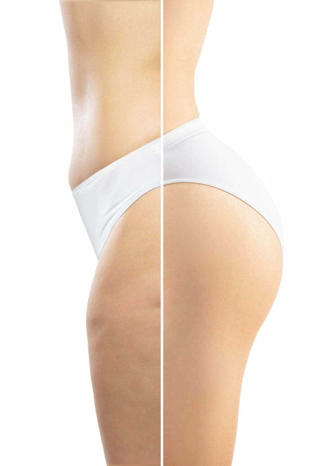 aparici&oacute;n de celulitis en cuerpo de mujer