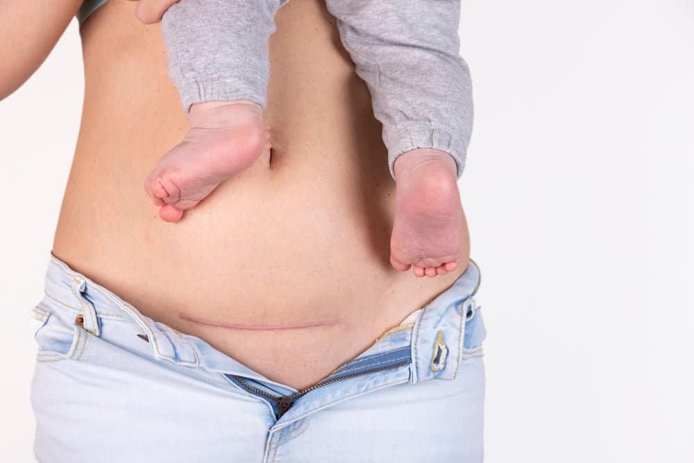 cicatriz de ces&aacute;rea, cinco meses despu&eacute;s de dar a luz