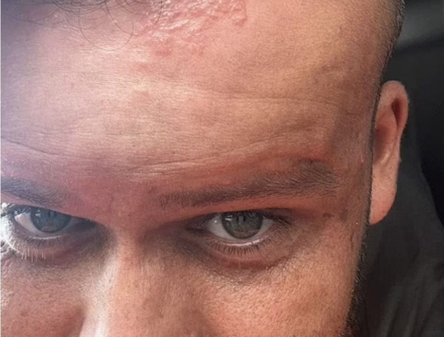 hombre se pint&oacute; el pelo y su cabeza se le hinch&oacute; de forma alarmante