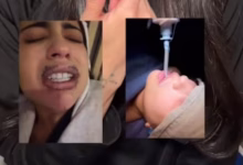 De un retoque est&eacute;tico a una pesadilla: joven denuncia que le inyectaron silicona con aceite industrial en los labios