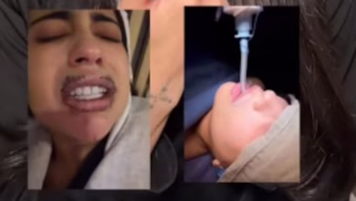 De un retoque est&eacute;tico a una pesadilla: joven denuncia que le inyectaron silicona con aceite industrial en los labios